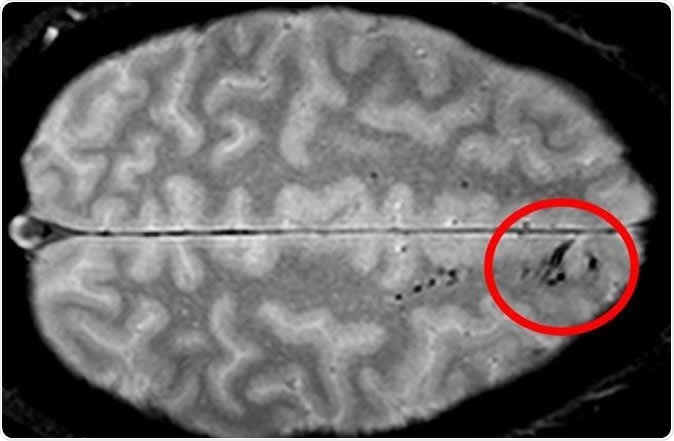 Traumatic microbleeds appear as dark lesions on MRI scans and suggest damage to brain blood vessels after head injury. Image Credit: Latour Lab/NINDS.