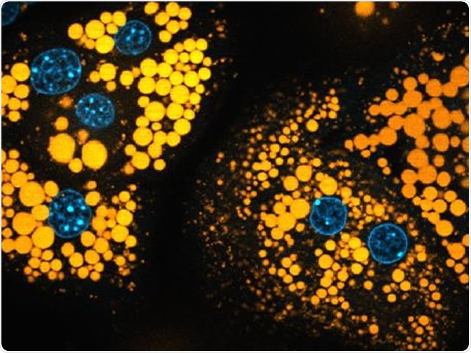 Picture of liver cells that are full of fat droplets (orange). The cell nuclei are shown in blue. Image Credit: © K. Piotrowitz/AG Thiele