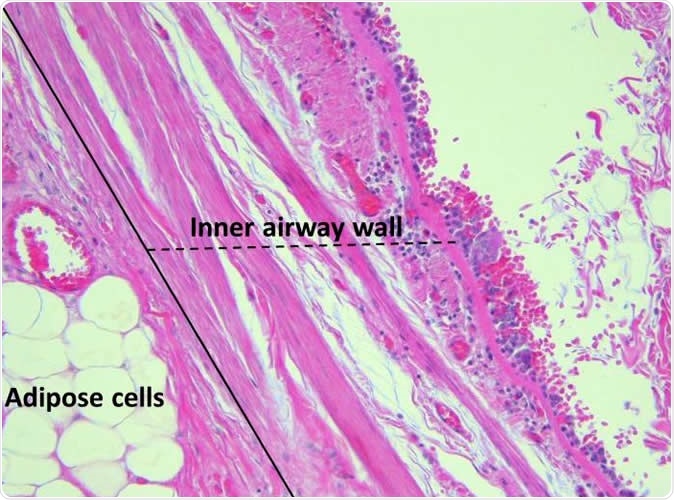 Micrographs (x200) of the (A.) outer airway wall, between the airway smooth muscle (ASM) layer and the airway adventitia (dashed line) showing adipose tissue and mucous glands and (B.) inner airway wall (submucosa), between the basement membrane and ASM layer (dashed line) in a case of fatal asthma stained with haematoxylin and eosin. Inflammatory cells were counted within the inner airway wall. Image Credit: European Respiratory Journal