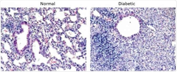 Lung sections from 21 days after infection with MERS-CoV in normal mice (left) and diabetic mice (right). We find that normal mice resolve the inflammation faster than diabetic mice leading to prolonged weight loss and disease in the diabetic mice. Image Credit: University of Maryland School of Medicine
