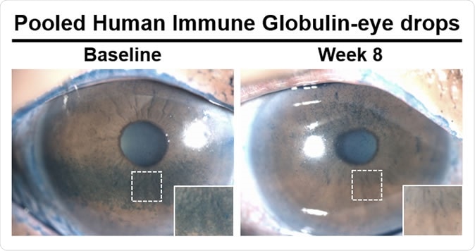 Patients treated with antibody-based eye drops saw reduced amounts of dry areas (blue spots) on the surface of the eye after eight weeks. Image Credit: Sandeep Jain, et al