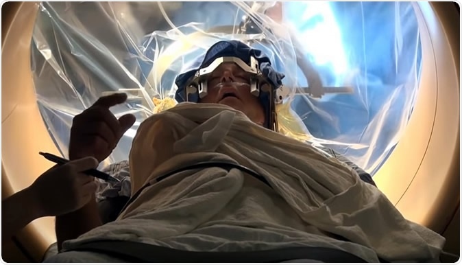Deep Brain Stimulation. Image Credit: Mount Sinai Health System