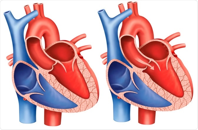 Descriptive illustration of aortic valve stenosis, the main artery that carries blood out of the heart, the aortic valve does not open completely and decreases blood flow from the heart. - Illustration Credit: ilusmedical / Shutterstock