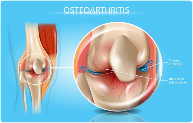 Osteoarthritis - Image Credit: TeraVector / SHutterstock