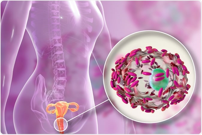 Bacterial vaginosis. Vaginal secretions contain epithelial cells, so-called clue cells covered with bacteria Gardnerella vaginalis, 3D illustration - Illustration Credit: Kateryna Kon / Shutterstock