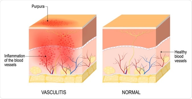 Vasculitis, damange of blood vessels by inflammation. Designua / Shutterstock