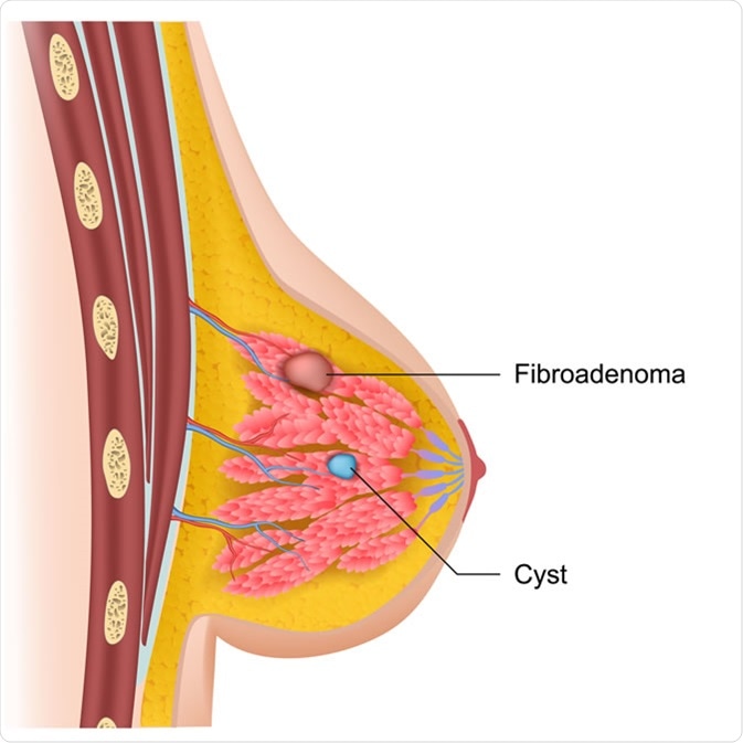 What are Breast Fibroadenomas?