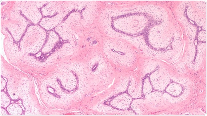 Breast Biopsy: Microscopic image (photomicrograph) of a fibroadenoma, a benign circumscribed tumor composed of both glandular and stromal tissue. - Image Credit: David A. Litman / Shutterstock