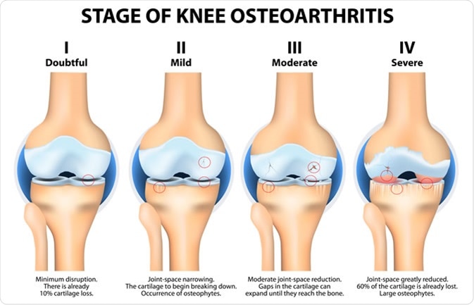 Stages of knee Osteoarthritis (OA). Image Credit: Designua / Shutterstock