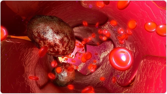 Tumour cells in blood vessels 3d illustration. Image Credit: Sciencepics / Shutterstock