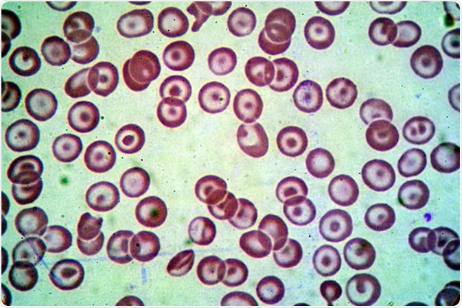 Blood smear under microscope showing Beta thalassemias Hb E and alpha(+) thalassemia. Credit: Medtech THAI STUDIO LAB 249 / Shutterstock