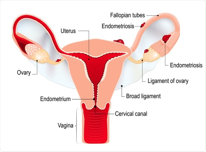 Endometriosis. Illustration Credit: Designua / Shutterstock