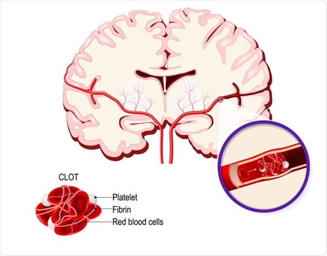 Blood clot in the human brain. Ischemic stroke in the cerebral artery and thrombus Image Credit: Designua / Shutterstock