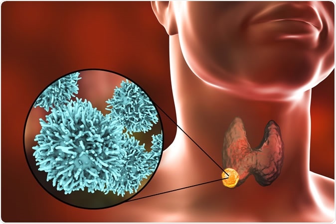 3D illustration showing thyroid gland with tumor inside human body and closeup view of thyroid cancer cells - Illustration Credit: Kateryna Kon / Shutterstock