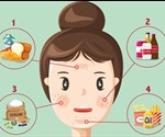 Diet a significant factor in acne outbreaks, finds pioneering new study