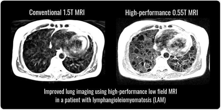 New high performance MRI versus conventional MRI