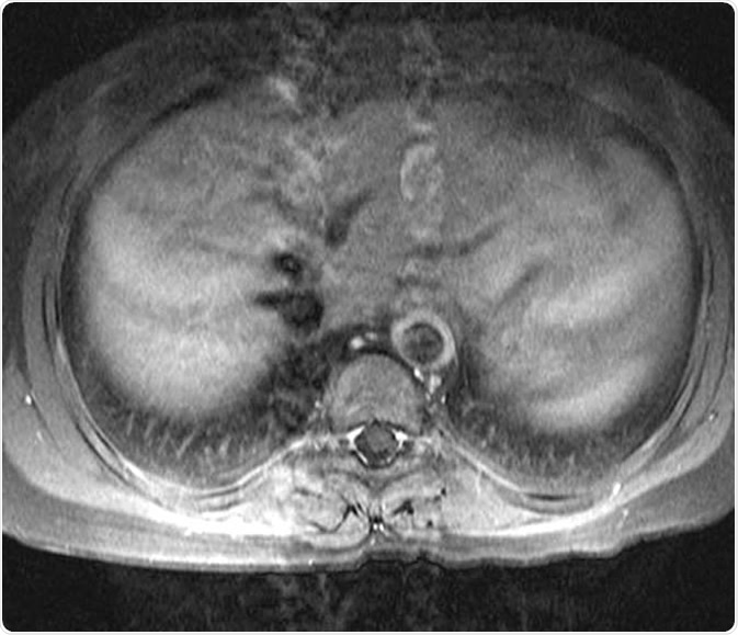 15 year-old female patient with known Takayasu arteritis presented for MRI to investigate back pain. The axial T1-weighted post-gadolinium MRI above shows thickened, enhancing aortic wall, consistent with large vessel vasculitis. Dr Laughlin Dawes, http://www.radpod.org/2007/04/15/takayasu-arteritis/