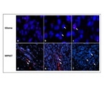 Researchers uncover novel molecular clues for tumor aggression in neurofibromatosis type 1