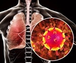 Patients with diabetes may have worse lung infections