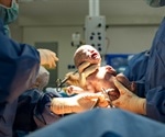 Is C-section good for childhood health?