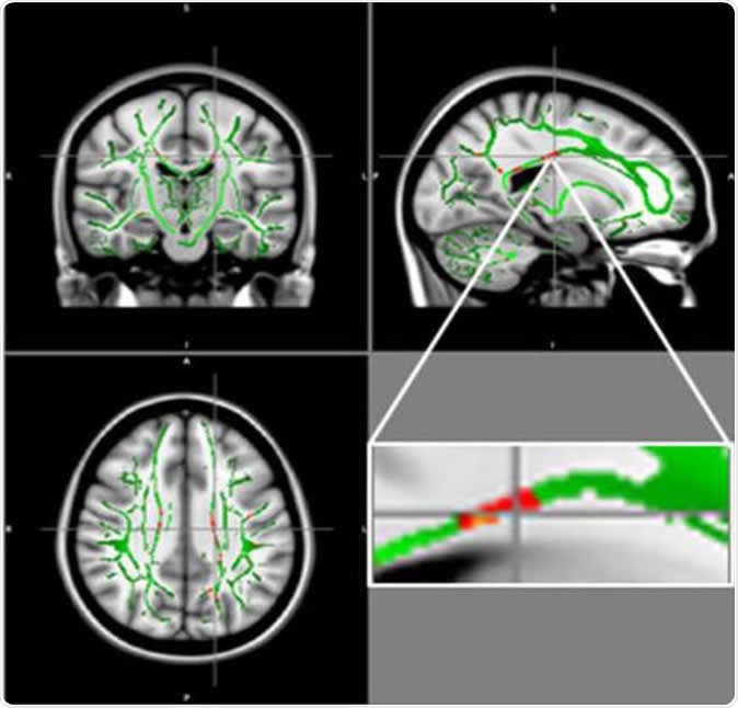 Reduction in fractional anisotropy (FA) in obese patients compared to the control group: At the intersection of the alignment vectors, a large cluster of FA decrease located in the corpus callosum on the left. In red: Reduction of FA in obese patients compared to controls, and FA skeleton (green), superimposed on the mean of FA images in sample.