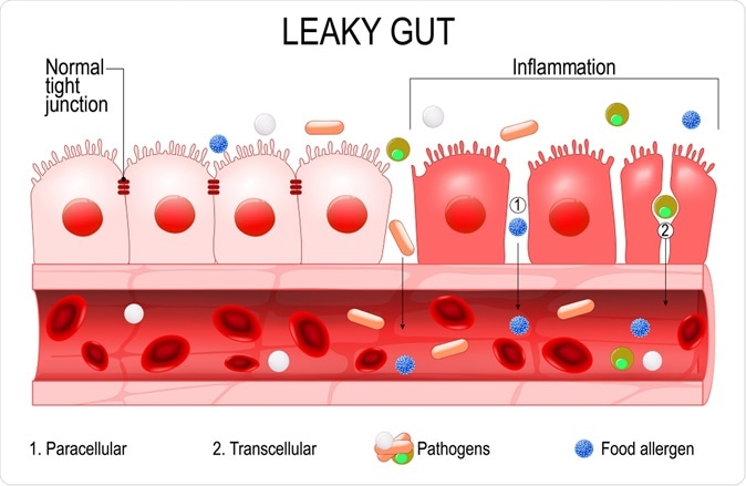 Leaky gut. - Illustration Credit: Designua / Shutterstock