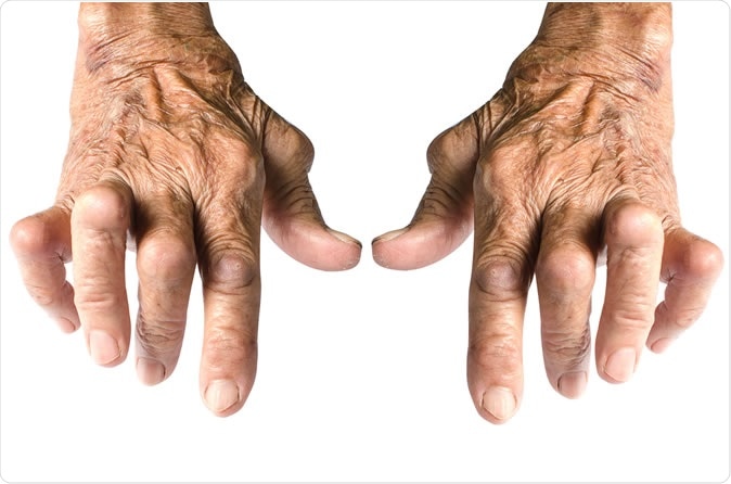 Study compared efficacy and safety of biological disease-modifying antirheumatic drugs (bDMARDs) between elderly-onset rheumatoid arthritis (EORA) and young-onset rheumatoid arthritis (YORA) patients. - Image Credit: Chaowalit Seeneha  / Shutterstock