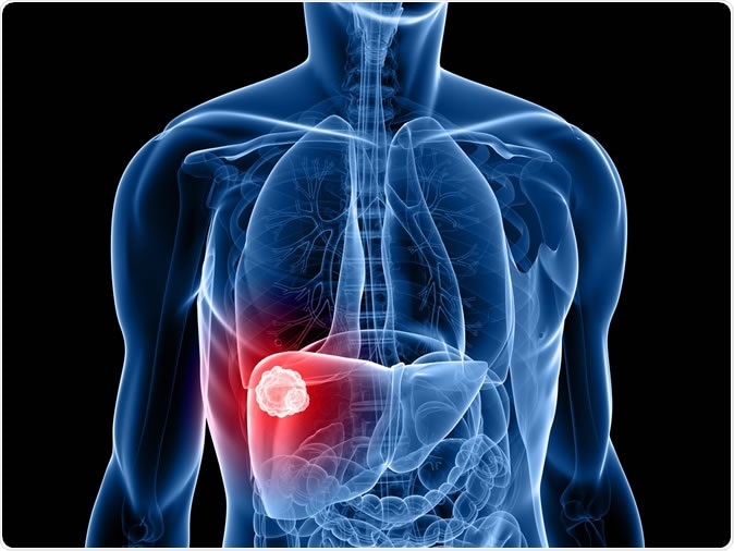 Liver cancer. Image Credit: Sebastian Kaulitzki / Shutterstock