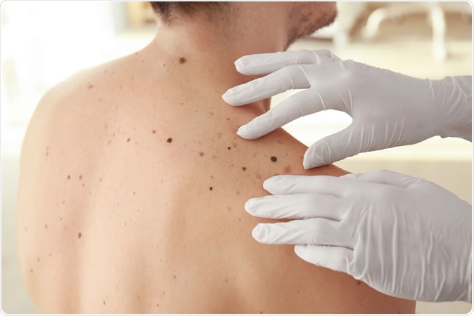 Dermatologist examining potential melanomas - Image Credit: Africa Studio / Shutterstock