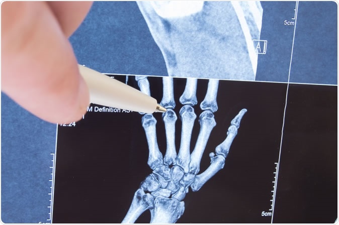 No studies have assessed the effect of methotrexate (MTX) in osteoarthritis of the hand (HOA). The purpose of this study was to examine the effect of MTX on pain and structural progression in symptomatic erosive HOA (EHOA). Image Credit:  Shidlovski / Shutterstock