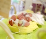 Doctors warn against umbilical cord milking in preterm infants
