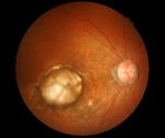 Age-related macular degeneration (AMD) may affect 77 million Europeans by 2050