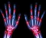 Newly discovered cell involved in rheumatoid arthritis could serve as treatment target