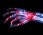 Rheumatoid arthritis linked to other diseases, finds new study
