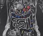 A type of gut bacteria may increase risk of bowel cancer