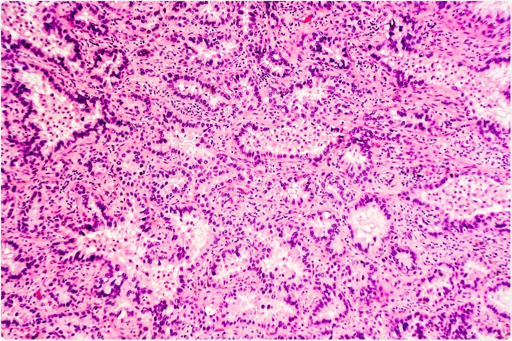 H&E stain of lung adenocarcinoma. (Image Credit: David A. Litman/Shutterstock.com)