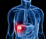 Deaths from liver cancer increased 3-fold over 20 years in England