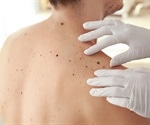 Some skin cancers originate in hair follicles, says new study
