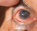 Glaucoma risk increased by air pollution