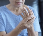 Methotrexate reduces joint damage in hand osteoarthritis