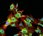 Discovery of novel mechanism by which certain breast cancers can metastasize