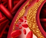 Heart-healthy diet is low in cholesterol, says AHA yet again