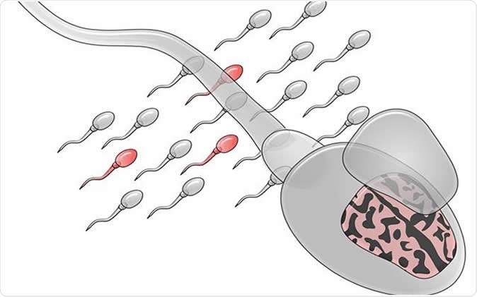 Illustration of sperm mosaicism, mutated sperm are depicted in red. Credit: UC San Diego Health Sciences