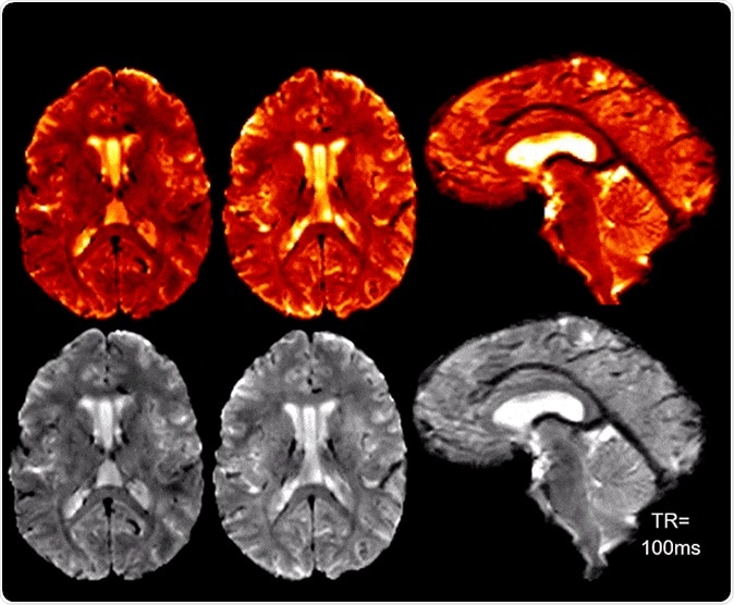 High SNR/CNR allows for real-time 7T MRI for brain pulsatility and CSF flow measurements. Credit: Radiofrequency (RF) Research Facility.