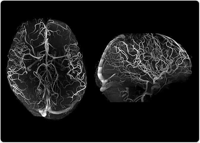 7T angiography in late life depression patients with the “Tic-Tac-Toe” RF coil system and without the use of invasive contrast agents. While not feasible at 3T, 7T super high-resolution acquisitions (voxel size is 0.2 mm in all directions) significantly improve the conspicuity of small arterioles.