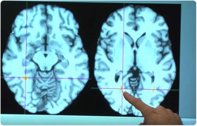 Brain MRI images