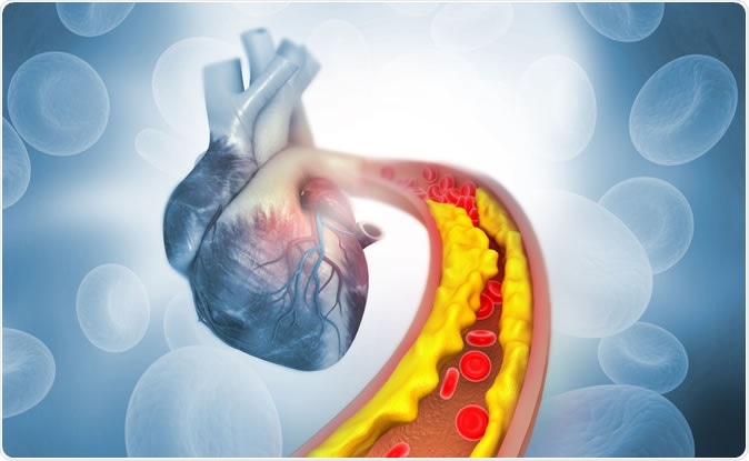 Cholesterol plaque in artery. 3d illustration Credit: Explode / Shutterstock