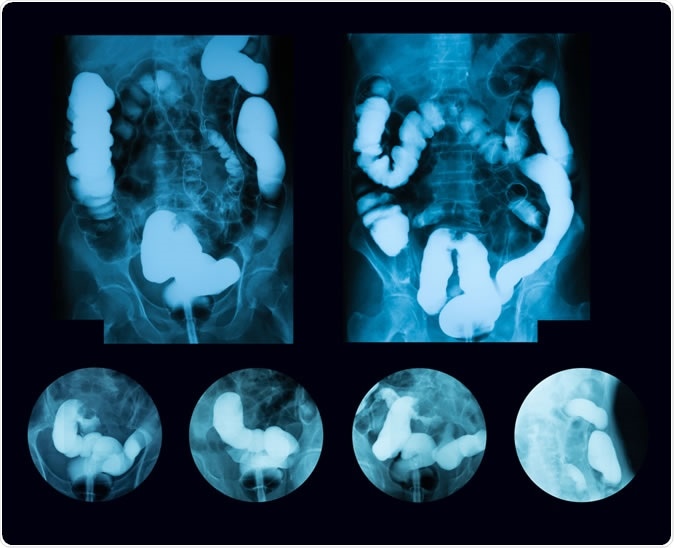 Barium enema double contrast, case of sigmoid colon cancer (Inflammatory Bowel Disease: IBD). Image Credit: Suttha Burawonk / Shutterstock