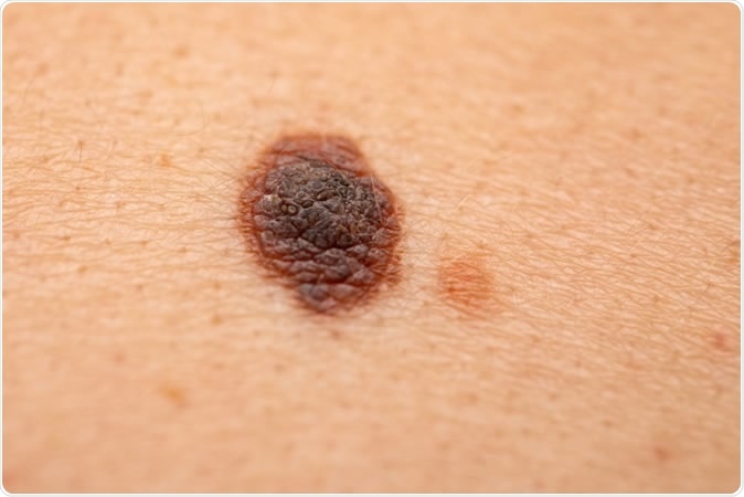 Close up of melanoma. Ocskay Mark / Shutterstock
