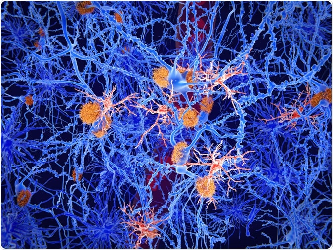 Microglia cells (red) play an important role in the pathogenesis of Alzheimer